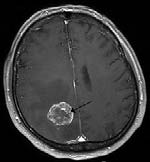 Tumor Detection using Mr Images Through Pixel based Methodology BWoutline = bwperim(sub2); By using 'bwperim' perimeter binary image are detected. By using 'strel'function of objects in b) d) images are converted to morphological structural element it creates a structuring element, SE, of the type specified by shape. h) Showing the performance parameter of tumor affected image and normal image For image processing technique image histogram and image profile both performance parameter are used. Image histogram of every processed image is shown by 'imhist' command of MATLAB. It is a chart that shows the distribution of intensities in an indexed or grayscale image. 'Imhist' function creates a histogram plot by making a number of equally spaced bins, each representing a range of data values. It then calculates the number of pixels within each range. Again 'improfile' computes the intensity values along a line or a multiline path in an image. It selects equally spaced points along the path is specified, and then uses interpolation to find the intensity value for each point. It also works with grayscale images and RGB images.